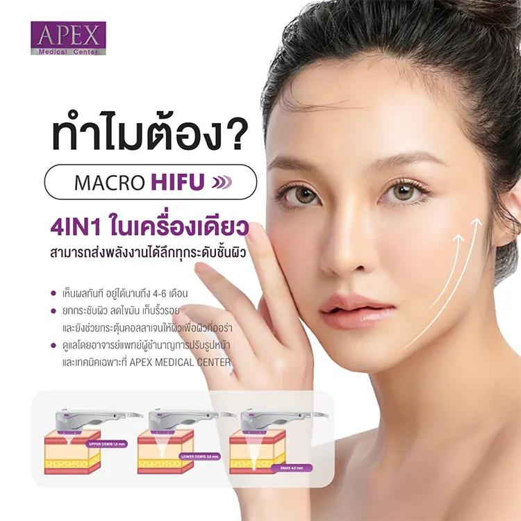 เครื่อง HIFU ทำงานอย่างไร