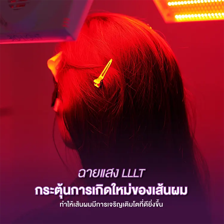 ปลูกผม LLLT