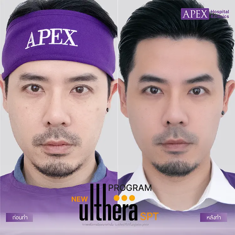ผลลัพธ์ Ulthera SPT