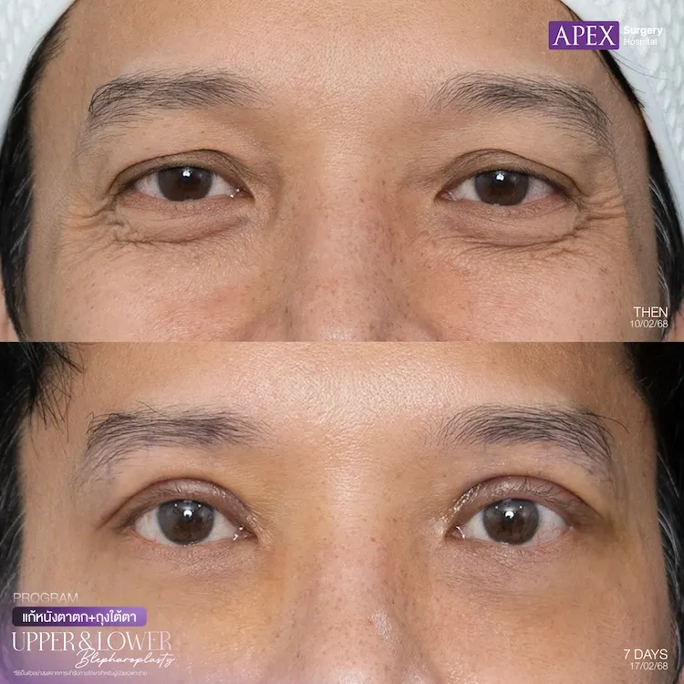 ผ่าตัดถุงใต้ตา รีวิว