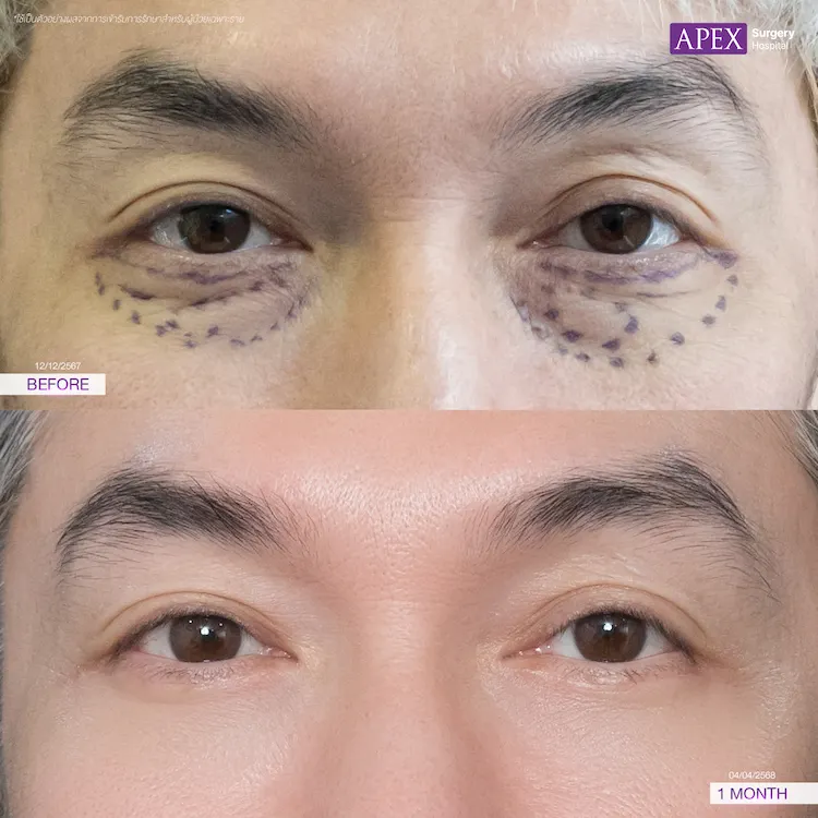 ผ่าตัดถุงใต้ตา รีวิว