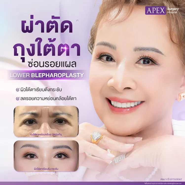 ผ่าตัดถุงใต้ตา