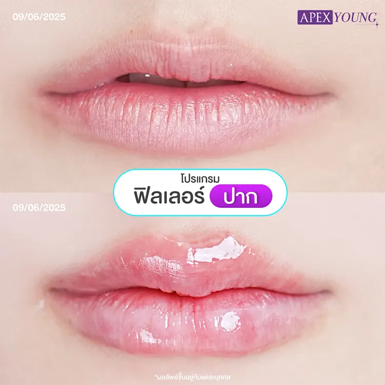 ฟิลเลอร์ปากที่ไหนดี