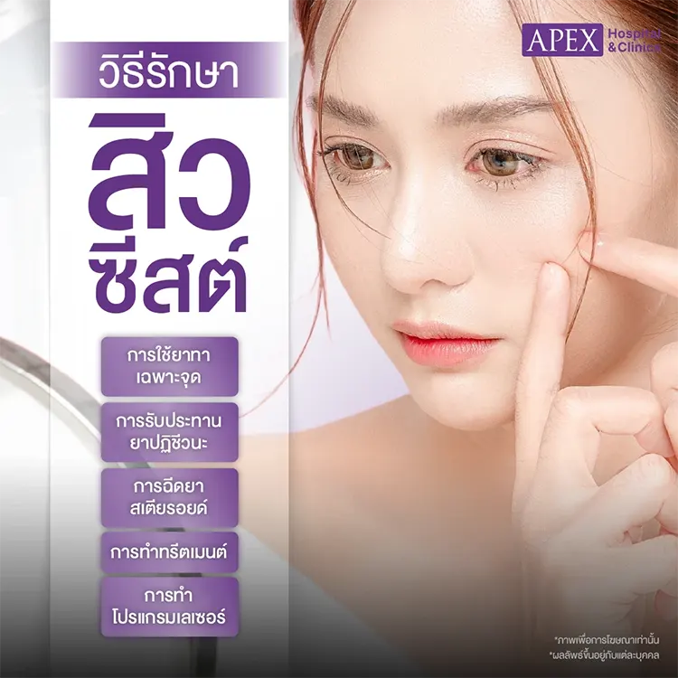 วิธีรักษาสิวซีสต์