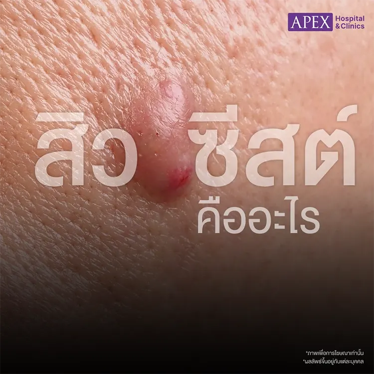 สิวซีสต์ คืออะไร