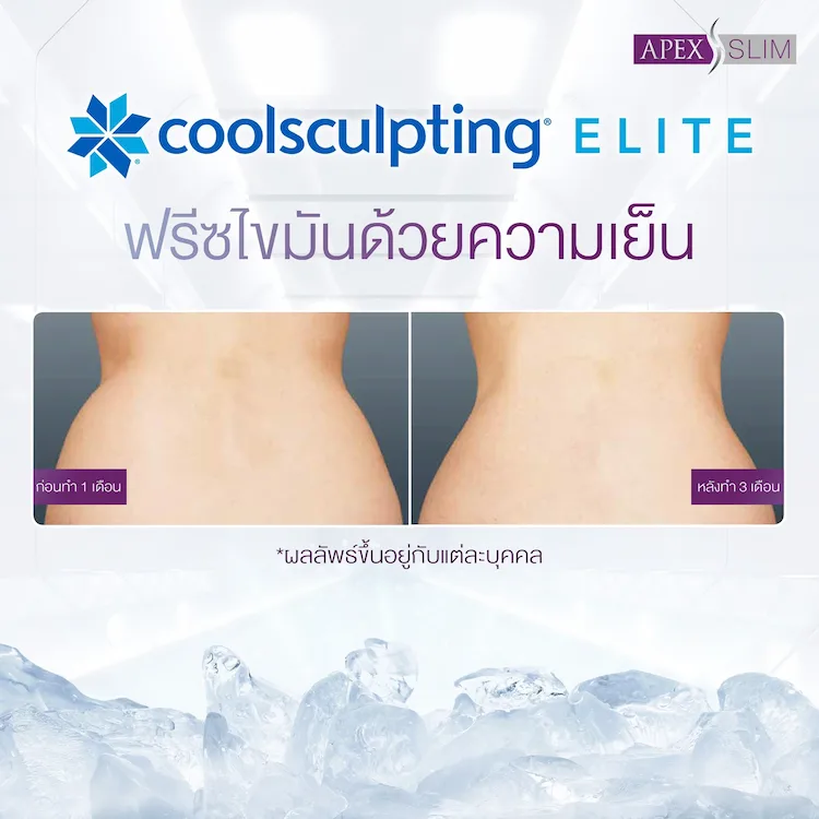 หลังทำ Coolsculpting Elite
