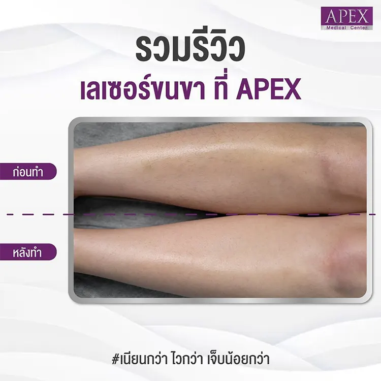 เลเซอร์ขนขา รีวิว