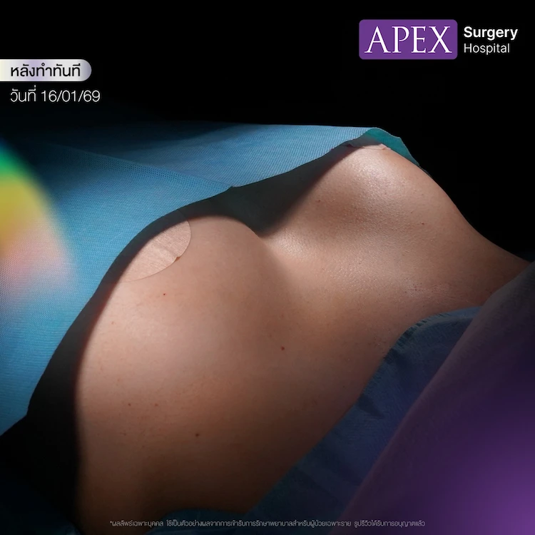 เสริมหน้าอก ราคา